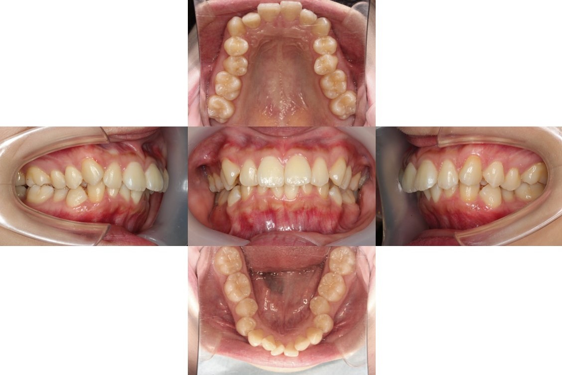 Eライン・ハーフ矯正の症例