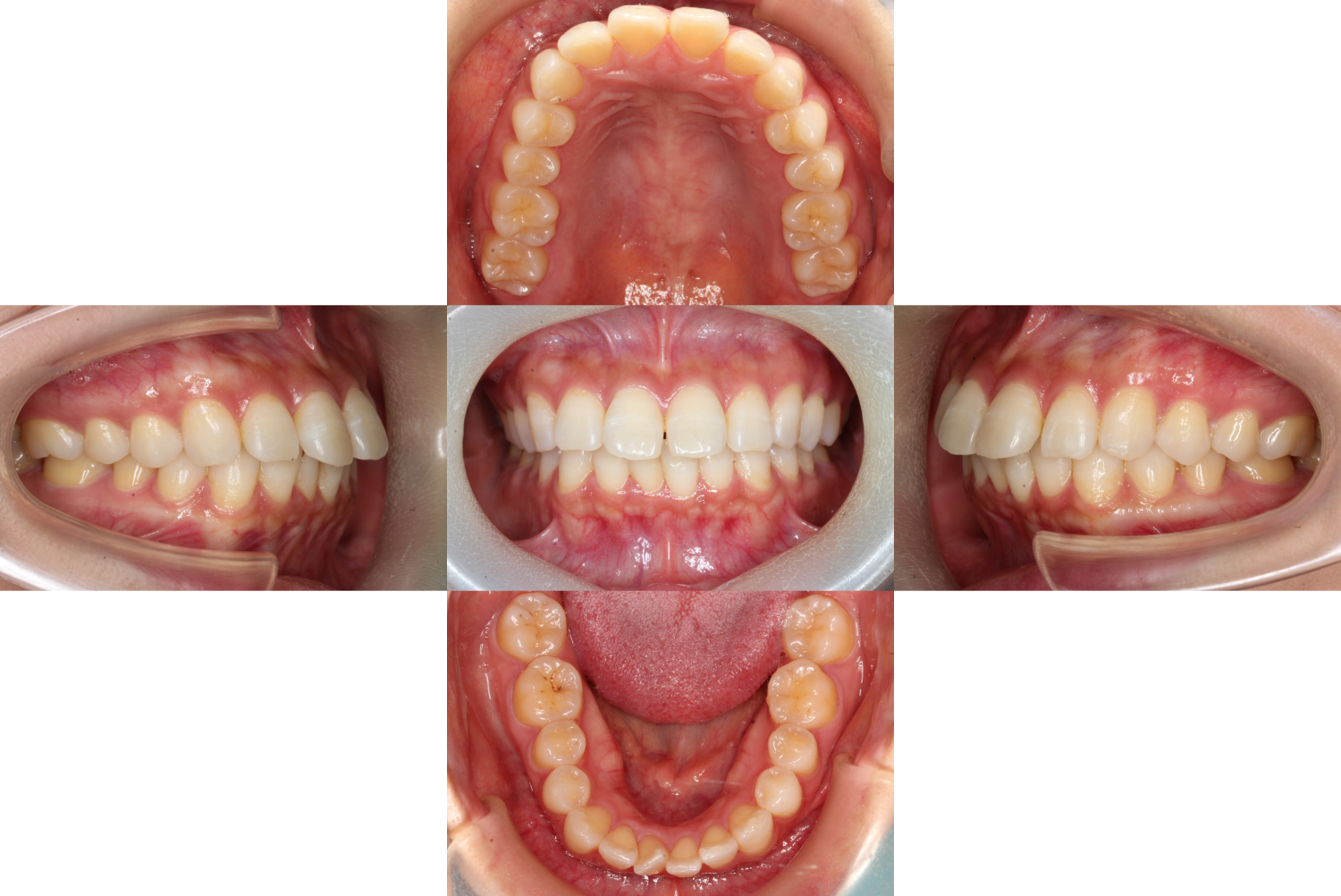 上顎前突・裏側矯正の症例
