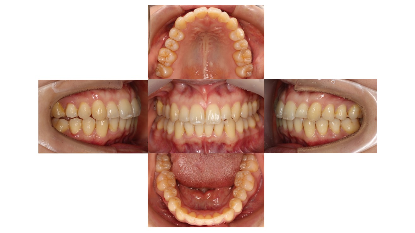 上下前歯の凸凹　マウスピース矯正　インビザライン