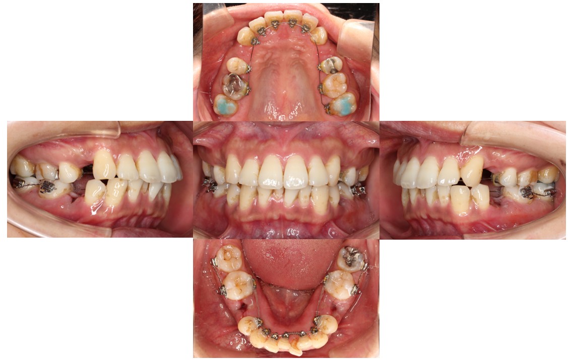 ガタガタ リンガル症例