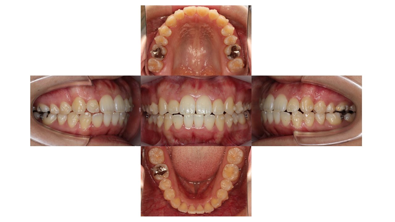 前歯の凸凹 八重歯 マウスピース矯正 インビザライン