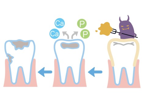 虫歯と酸蝕症の違い
虫歯菌　酸で歯が溶ける
