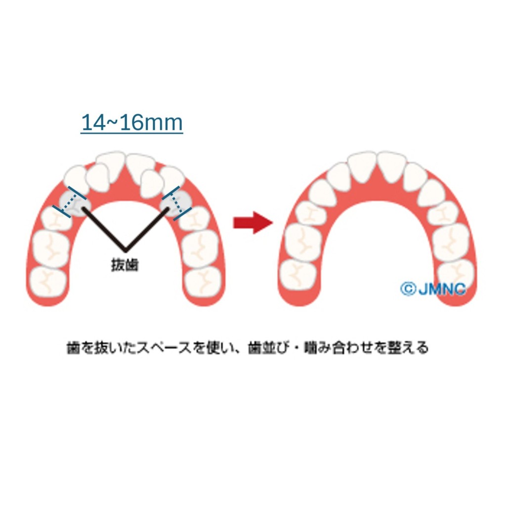 抜歯矯正　非抜歯矯正