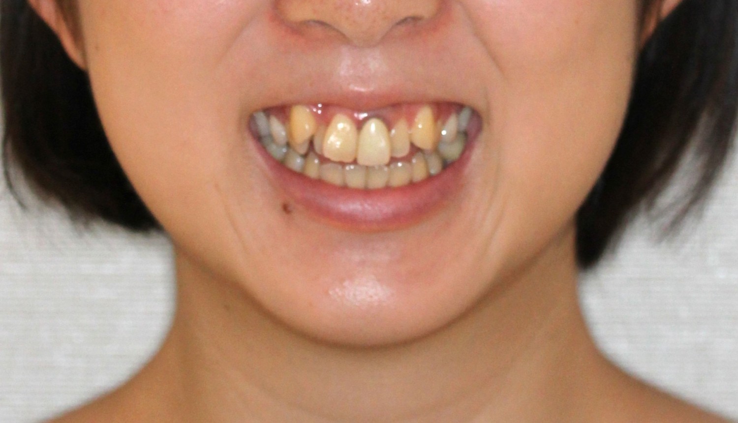 叢生・リンガル症例