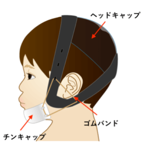 チンキャップ　受け口　治療　矯正