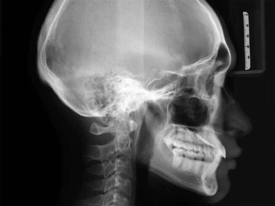 セファロ　精密検査　矯正歯科
