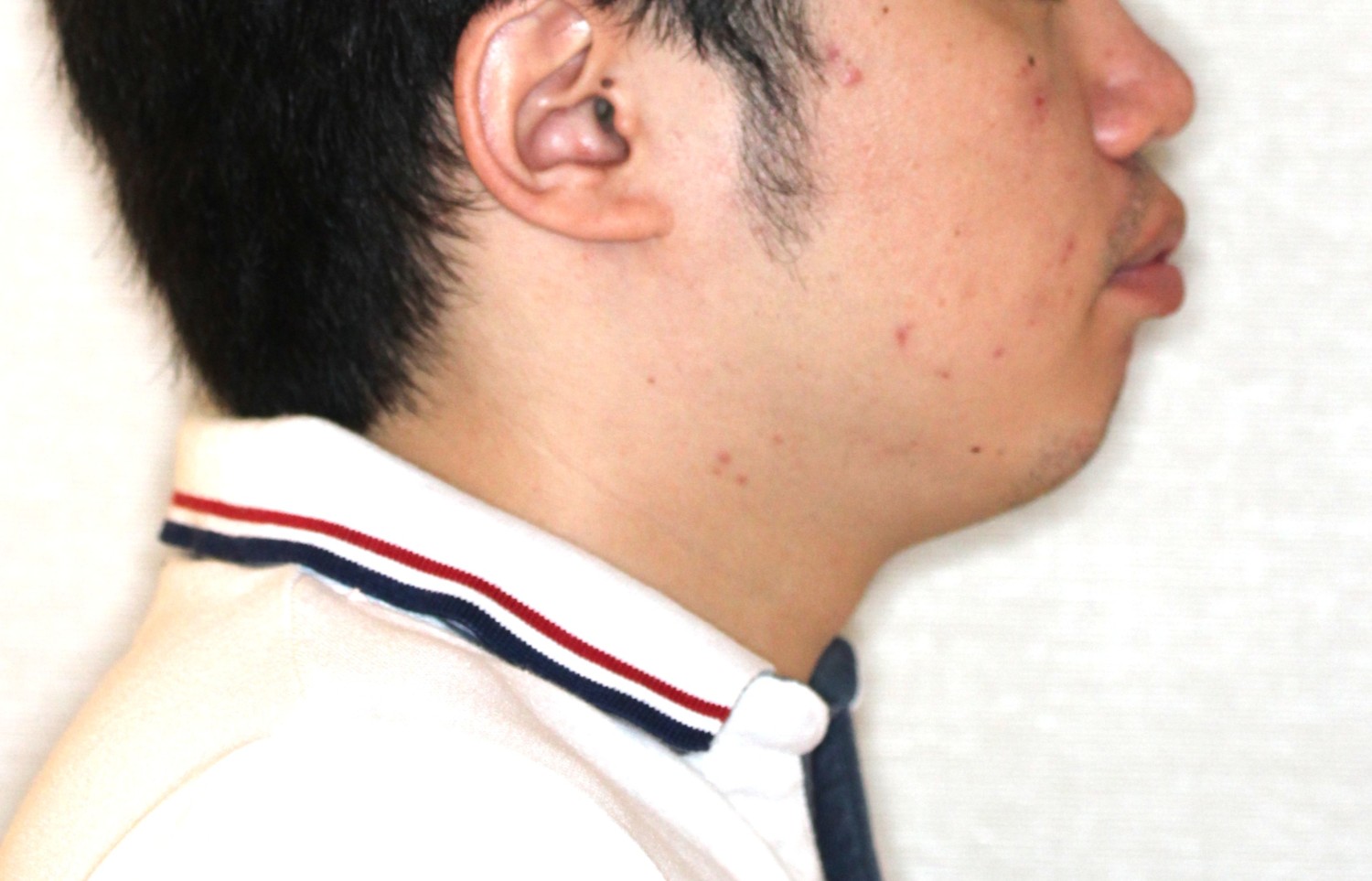 出っ歯・裏側矯正の症例