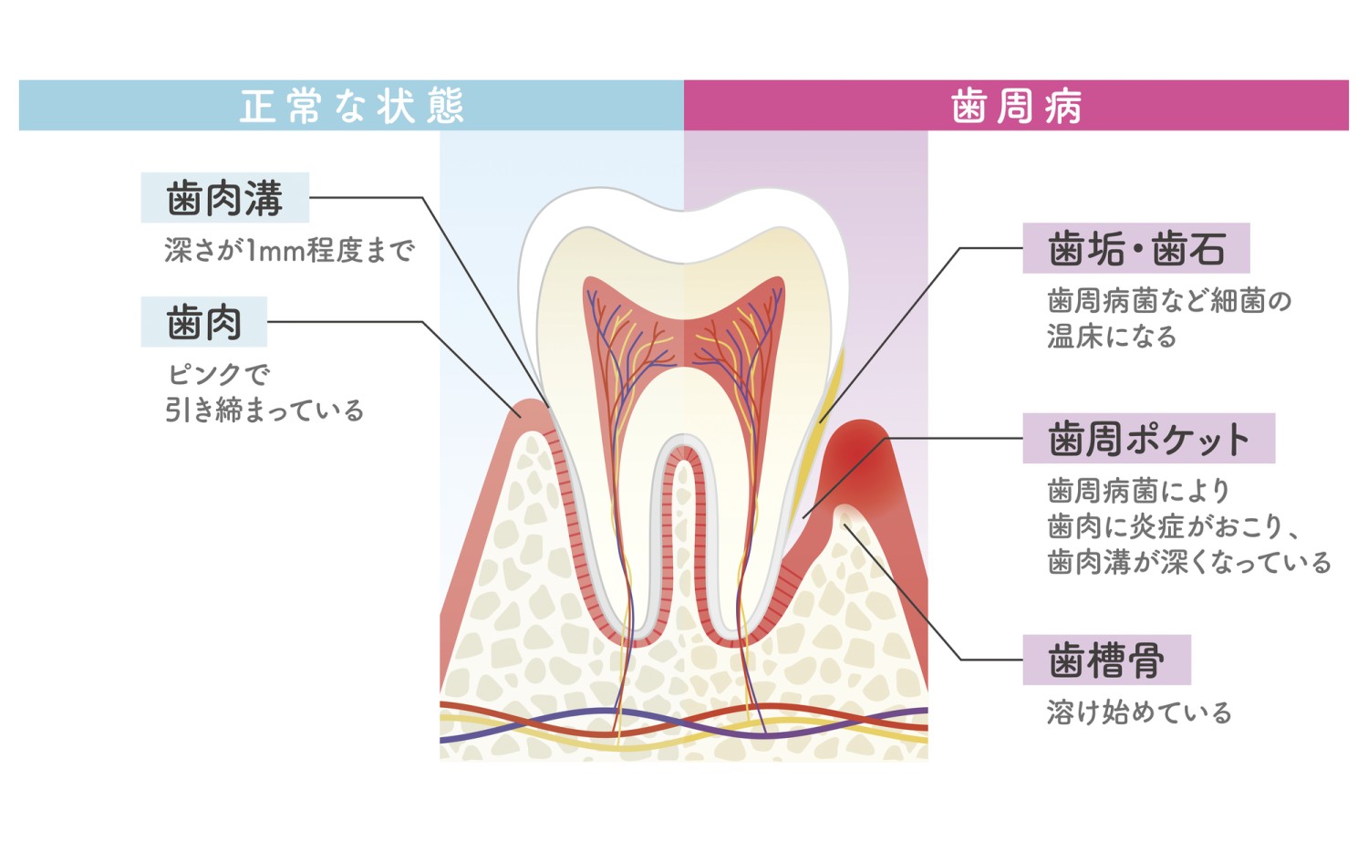 歯周病　歯槽骨　