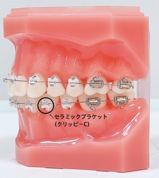 矯正装置　目立たない　矯正治療　表側矯正　ラビアル矯正　クリッピーC　セラミックブラケット