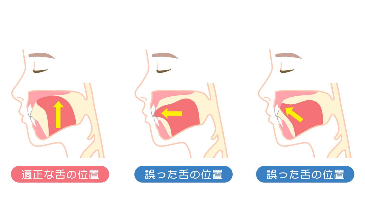 Eライン　口元下げる　出っ歯　舌の位置