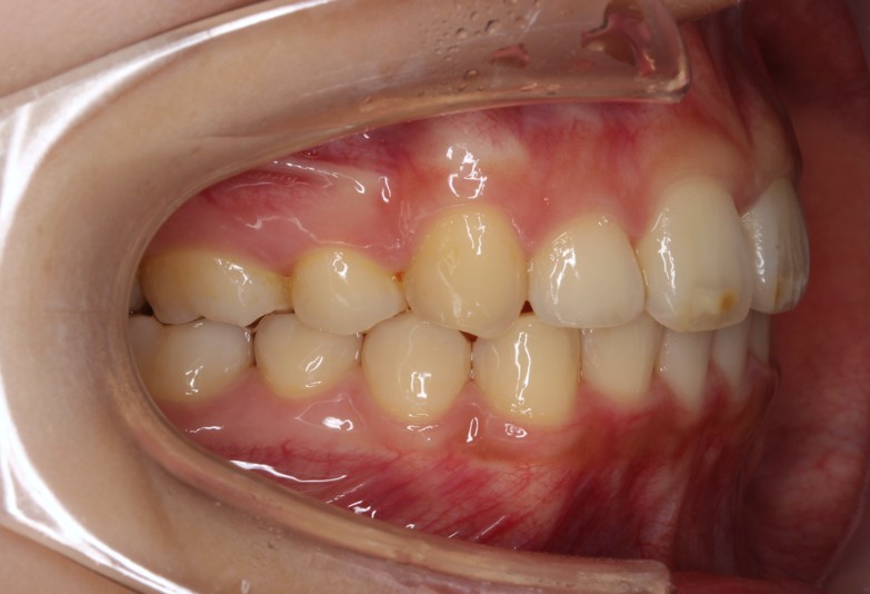 上顎前突・裏側矯正