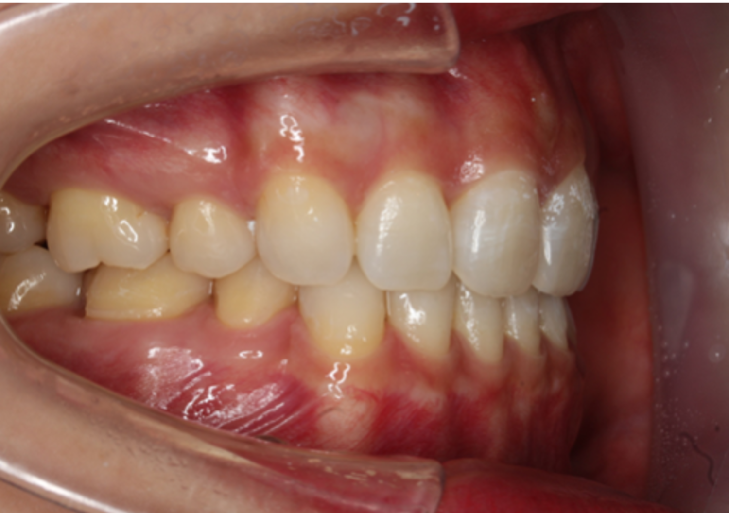 上顎前突・裏側矯正の症例