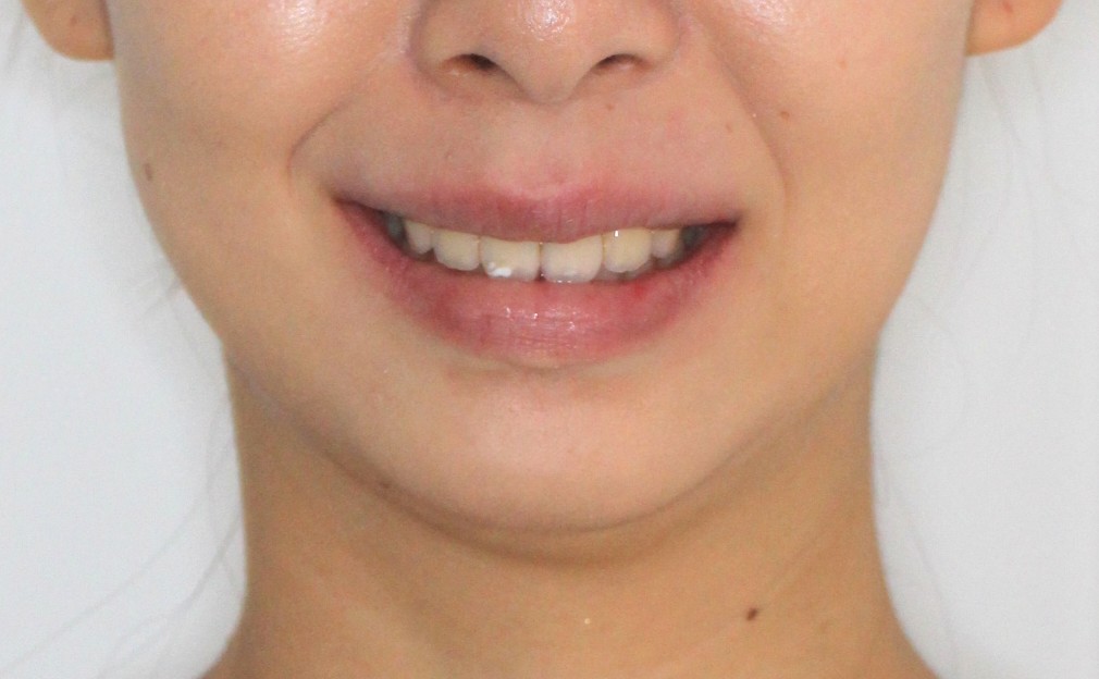 上の歯出ている、裏側矯正症例