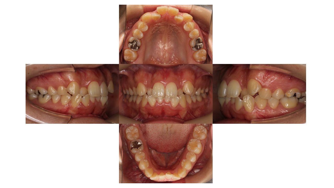 前歯の凸凹 八重歯 マウスピース矯正 インビザライン