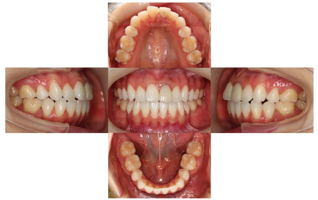 叢生・リンガル症例