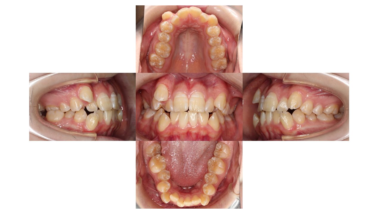 前歯凸凹 八重歯 裏側矯正 リンガル矯正