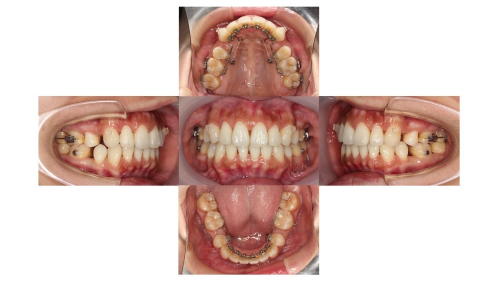 出っ歯改善・裏側矯正