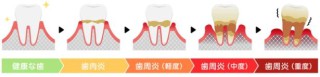 歯並び変化　歯周病