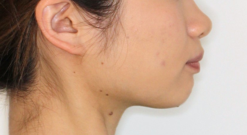 Eライン・ハーフ矯正の症例