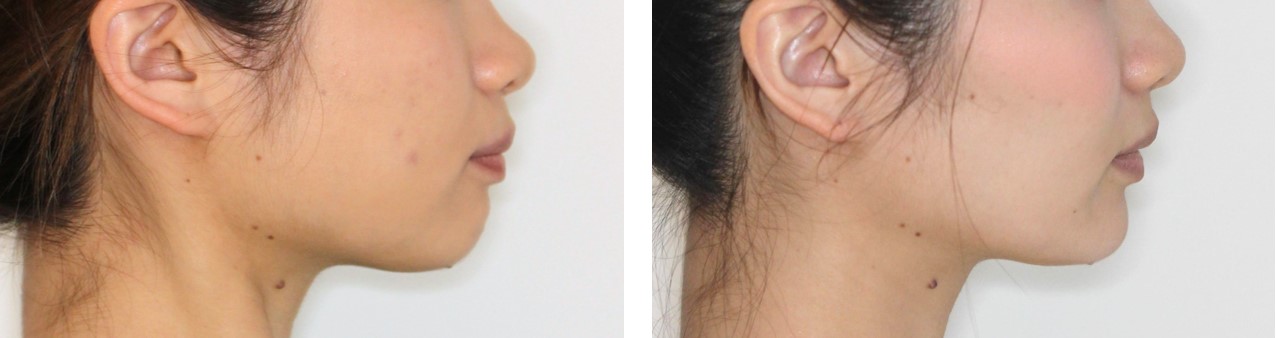 Eライン・ハーフ矯正