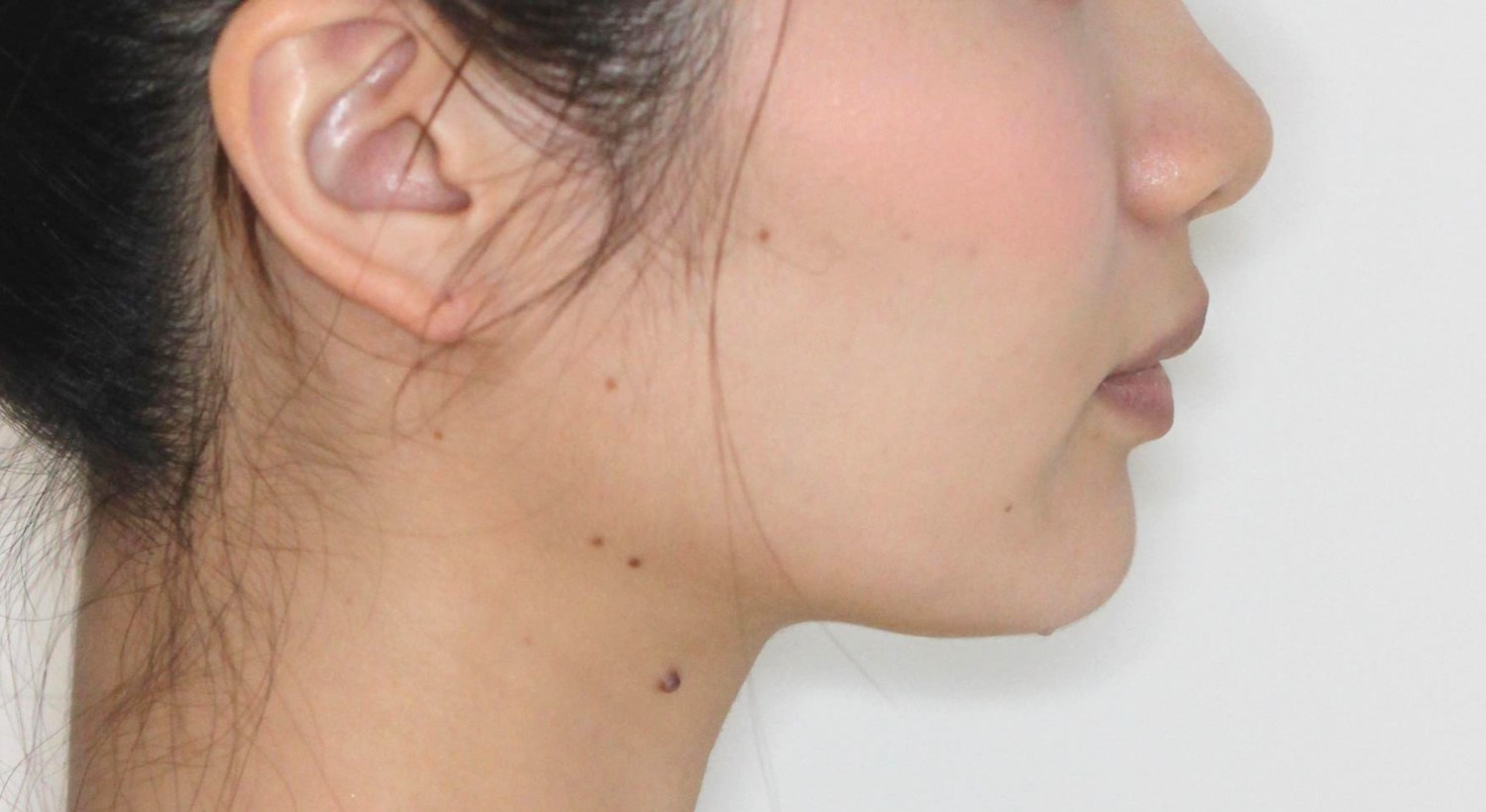 Eライン・ハーフ矯正