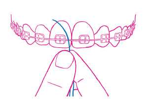 歯列矯正　矯正治療　デンタルフロス　フロアフロス　セイビング