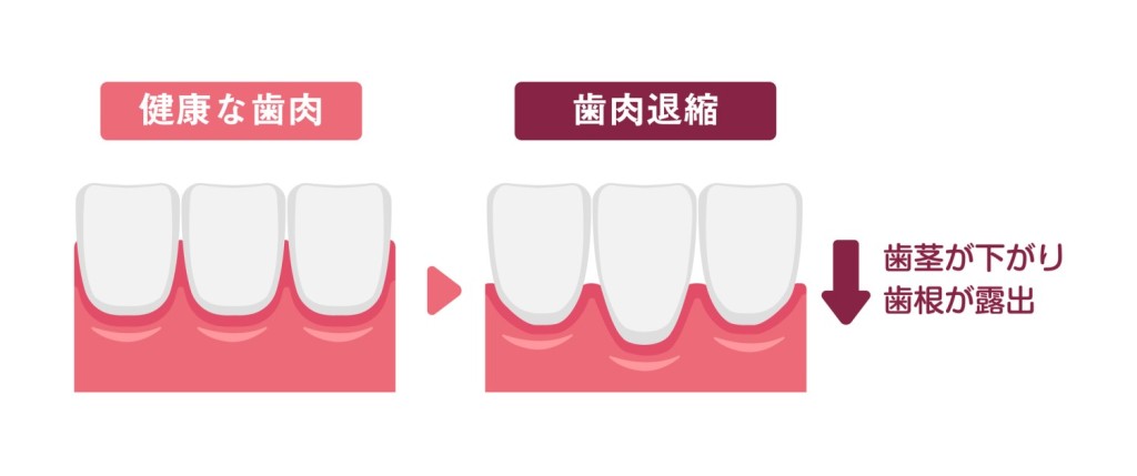 歯肉退縮 矯正 年齢制限 シニア リスク