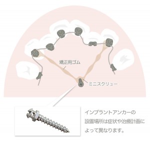 矯正治療とEライン