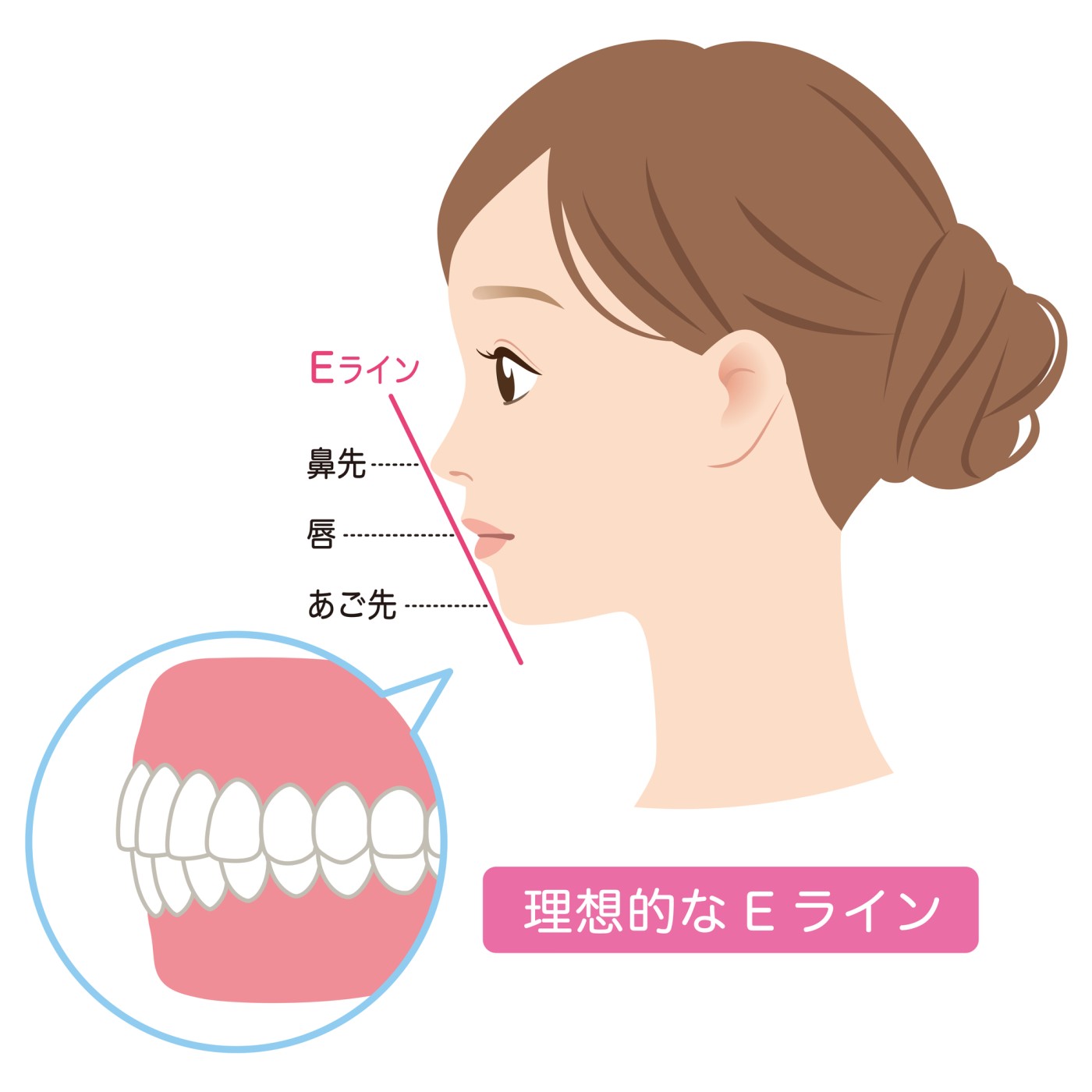 Eライン　口元下げる　出っ歯　　