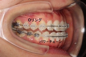 矯正器具　Oリング　パワーチェーン