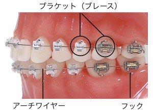 歯科衛生士オススメ矯正用歯ブラシ