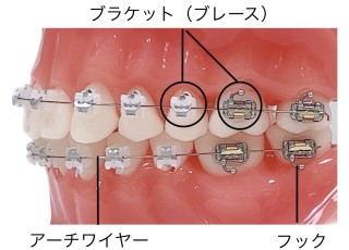 矯正治療　金属アレルギー