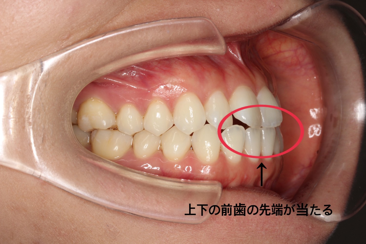 切端咬合　噛み合わせ悪い