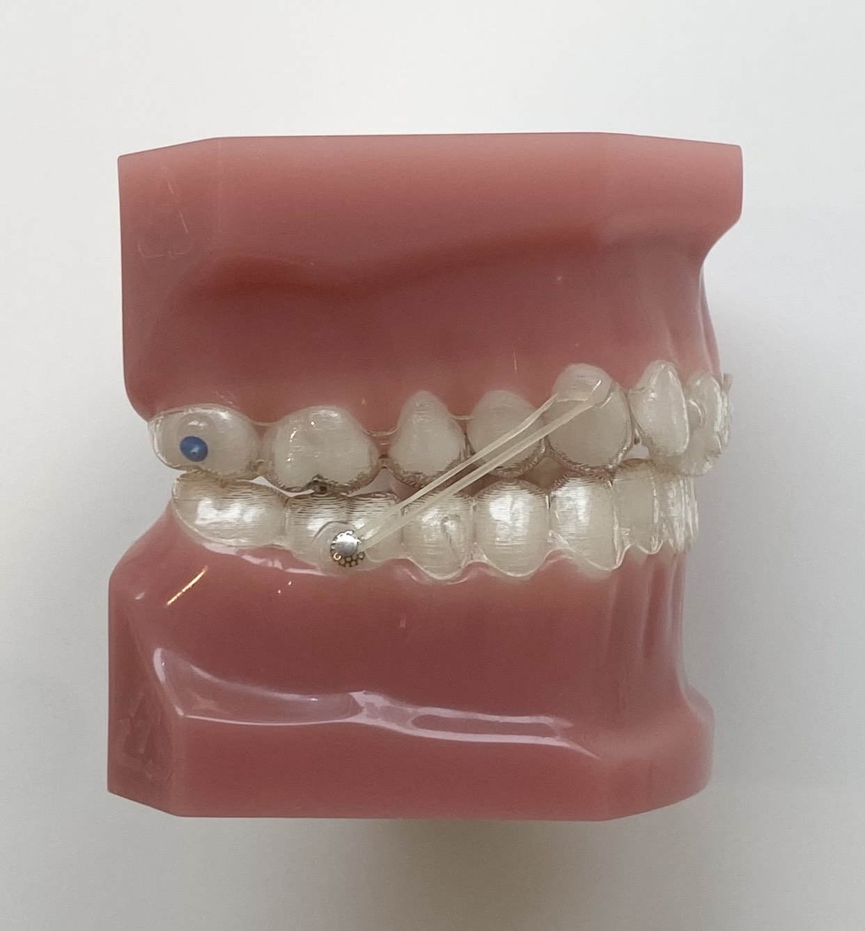 顎間ゴム　マウスピース矯正　２級ゴム