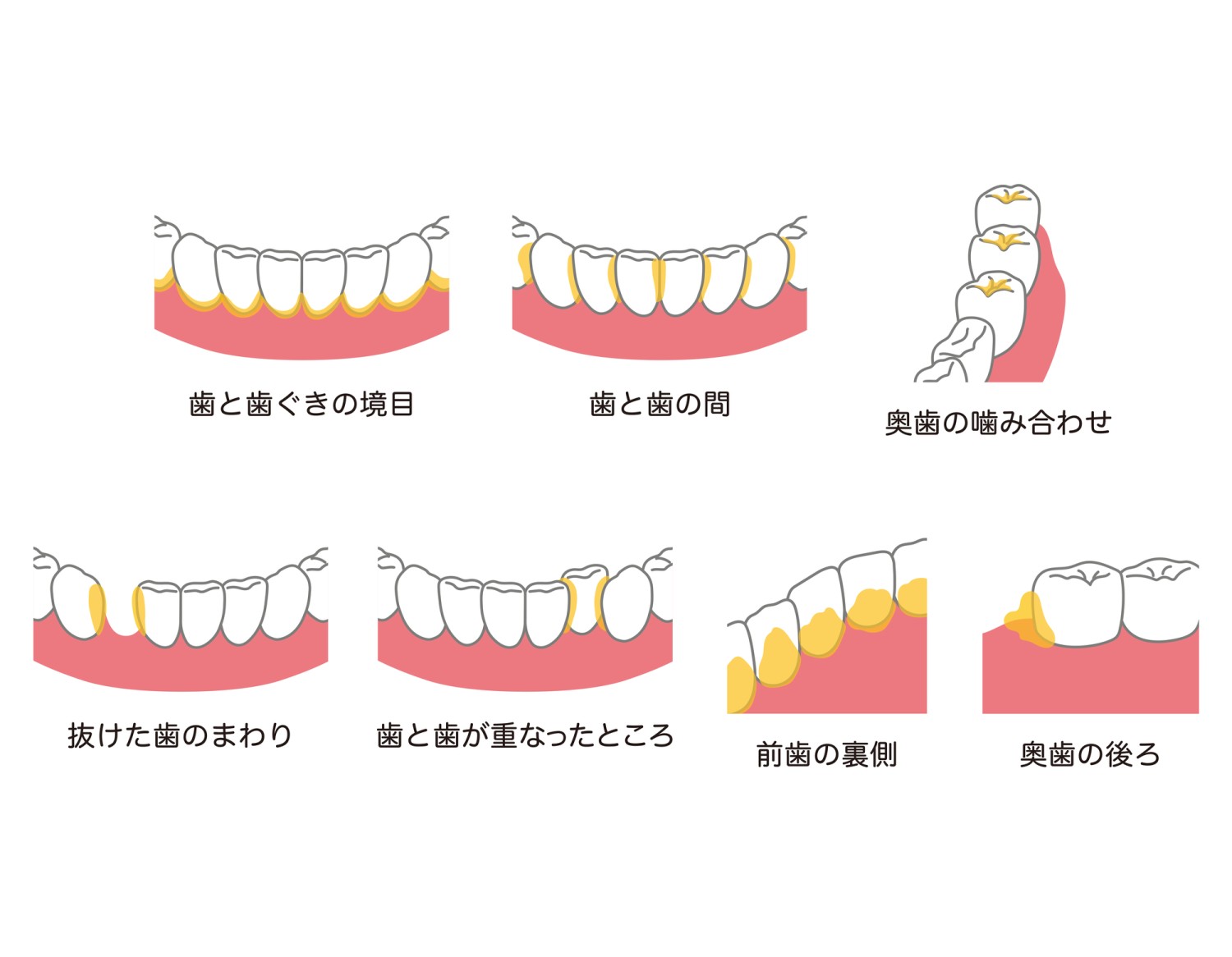 歯垢 プラーク 磨き残し