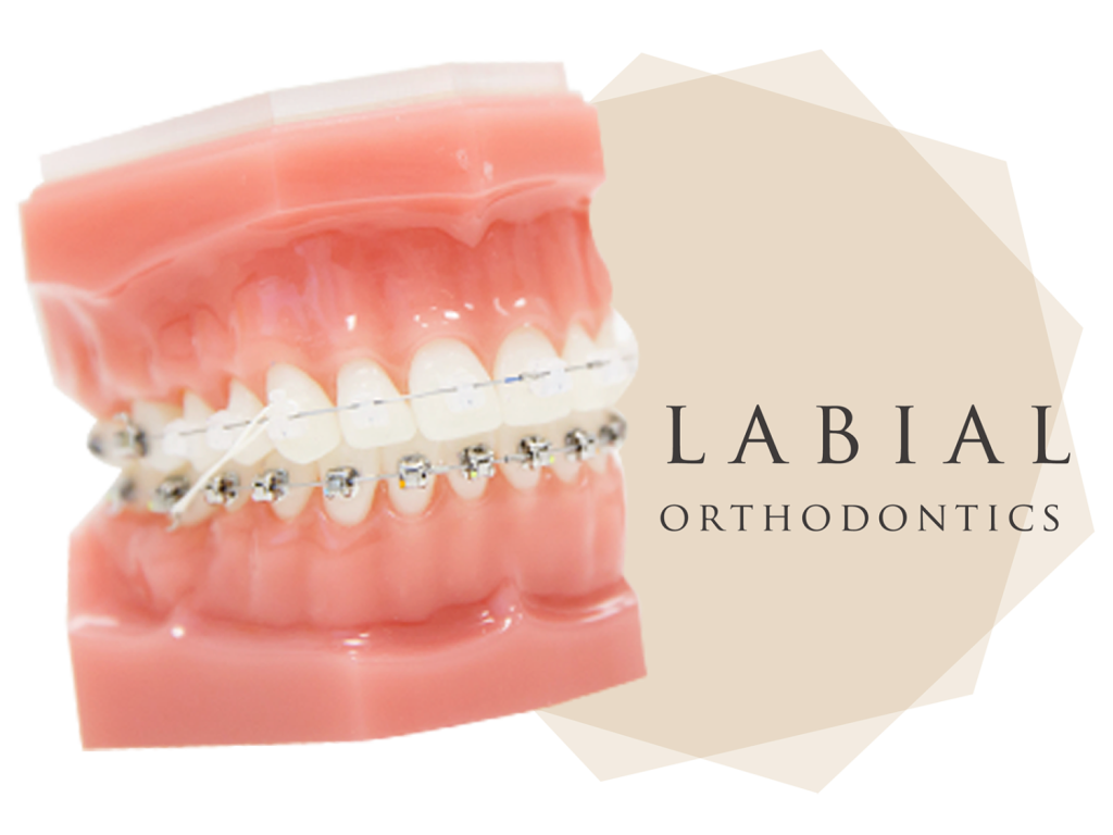 海外留学中だけど日本で矯正治療はできる？－一時帰国・短期滞 在中に進める方法