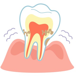 歯茎が腫れる原因