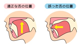 矯正したのに歯並びが悪くなるのはなぜ？原因とキレイな歯並びを保つ方法を解説