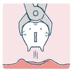 矯正治療における抜歯のメリット・デメリット