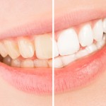 キレイ　笑顔　スマイル　条件　矯正