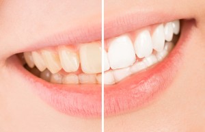 歯占い　白い歯　黄色い歯