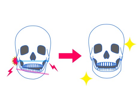 顎関節症　歯科矯正　歯列矯正　