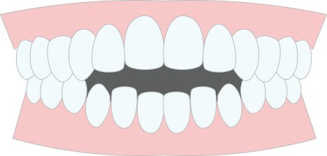開咬