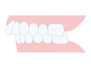 楽器で歯並び悪くなる？