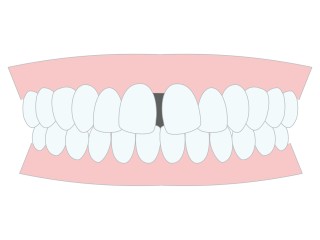 歯列矯正　歯科矯正　矯正治療　必要性　歯並び　チェック