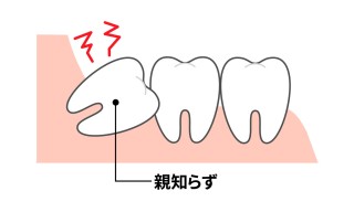 親知らず　矯正　関係　抜歯