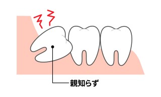 歯茎が腫れる原因