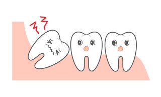 親知らず　矯正　関係　抜歯