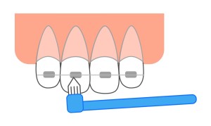 歯科矯正　ワイヤー　マウスピース