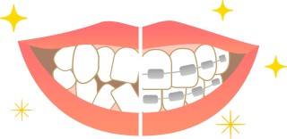 ガミースマイル　ガミー　逆ガミー　矯正　歯列矯正　改善　装置　